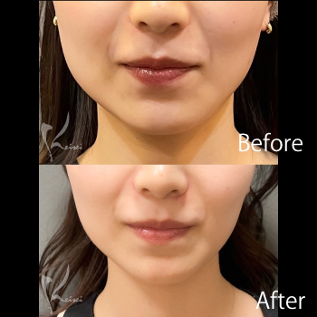 エラボトックスで定期メンテナンス　サムネイル