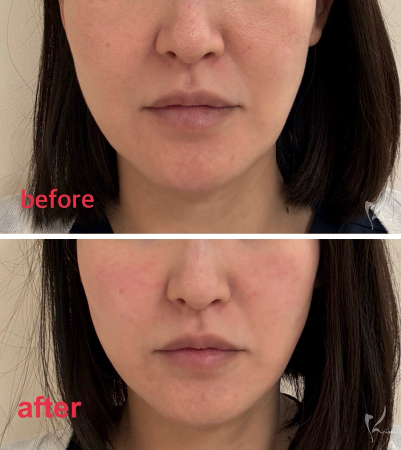 ビフォーアフター正面写真