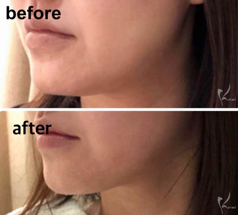 ビフォーアフター斜め写真