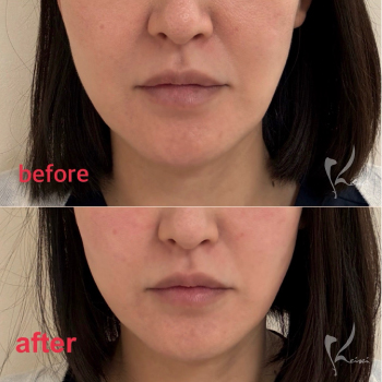 フェイスラインのもたつきにポテンツァ ダイアモンドチップ　サムネイル