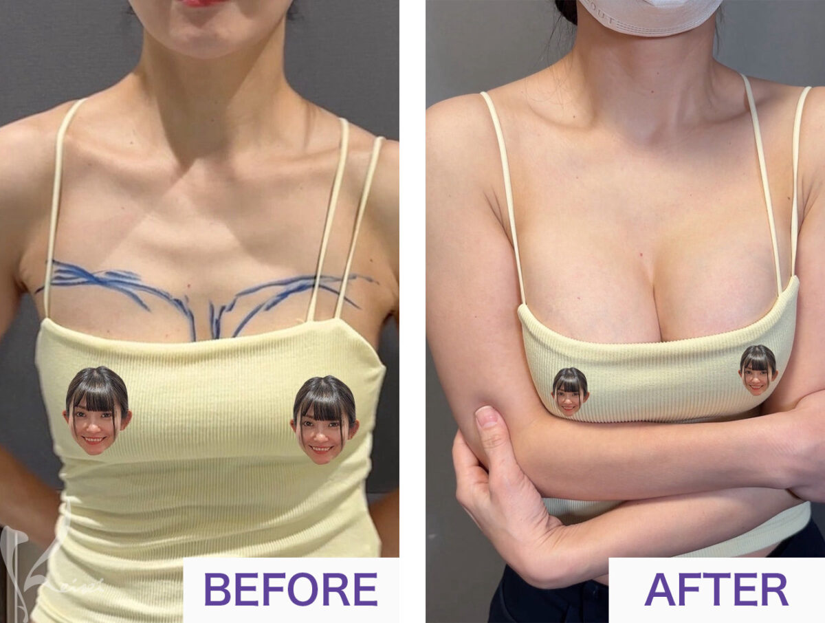 シリコンバッグ豊胸のBEFOREとAFTERの違い