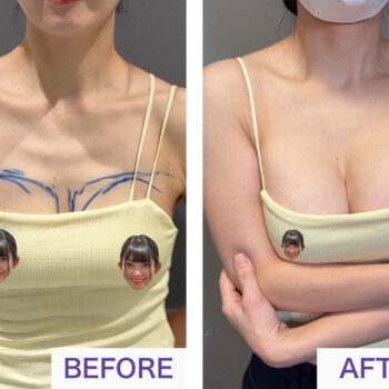 シリコンバッグ豊胸のBEFOREとAFTER