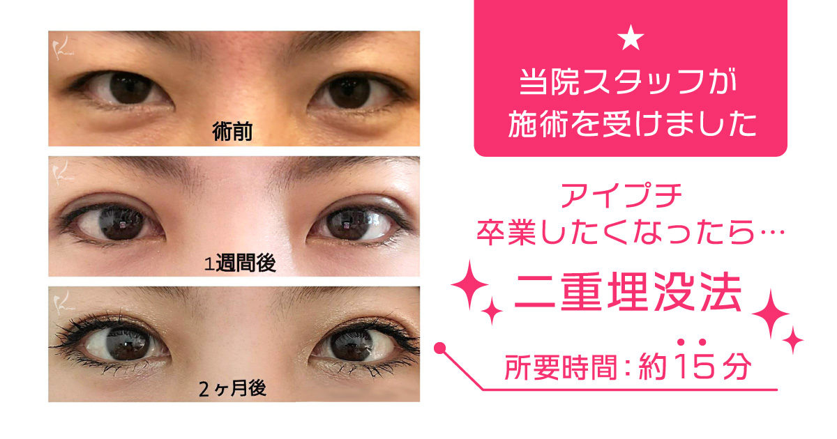 アイプチ卒業 恵聖会クリニック 大阪の美容外科 美容皮膚科 アイプチ卒業 恵聖会クリニック 大阪の美容外科 美容皮膚科