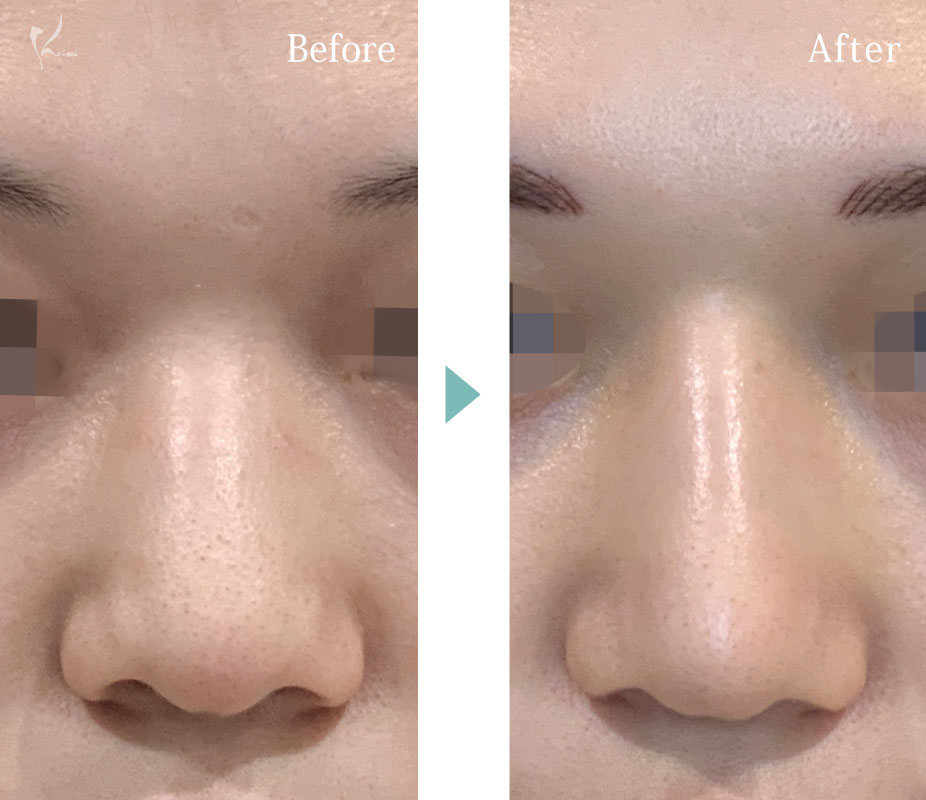 鼻のプロテーゼと鼻尖形成、ハンプ切除（鼻骨骨削り）の施術を行った正面からの症例写真