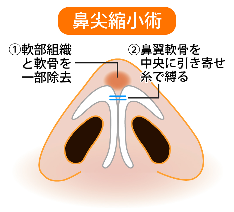 鼻尖縮小術１イメージ