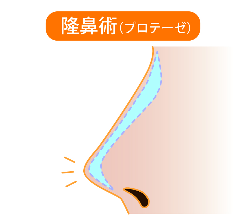 隆鼻術イメージ
