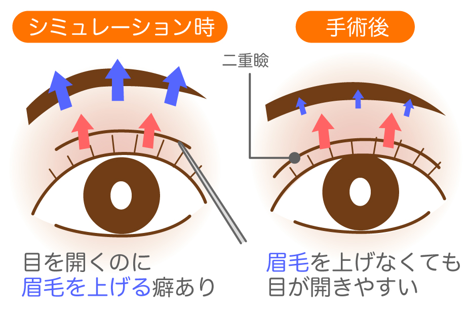 シミュレーション時と埋没法手術後の瞼の開き具合イラスト