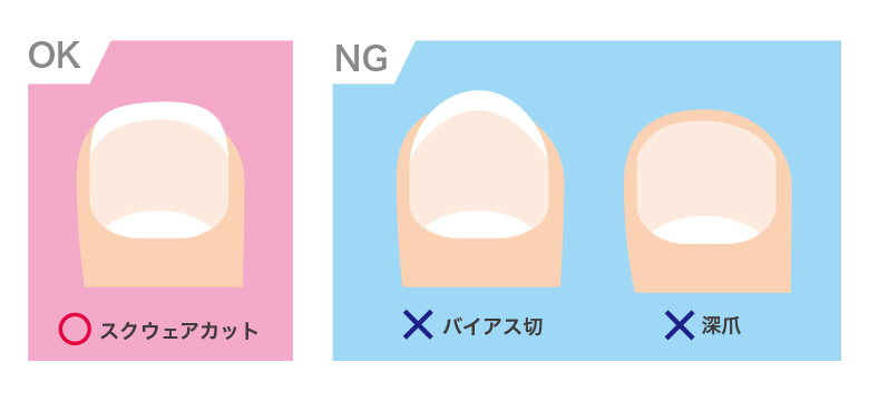 陥入爪を予防するための爪切り