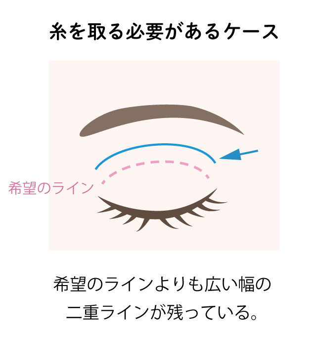 埋没法で糸を取る必要があるケース