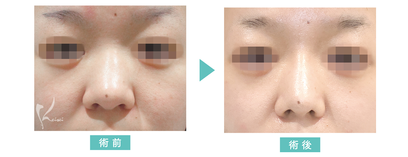 鼻プロテーゼ+鼻尖縮小+耳介軟骨移植の症例写真