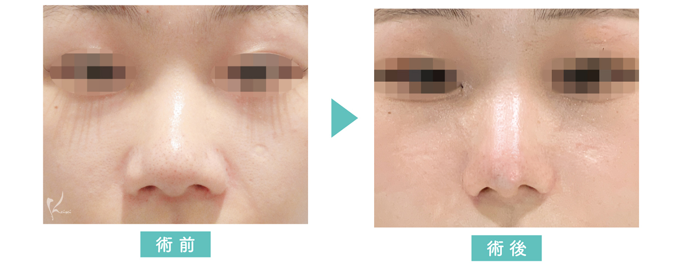 鼻プロテーゼ+小鼻縮小+耳介軟骨移植の症例写真