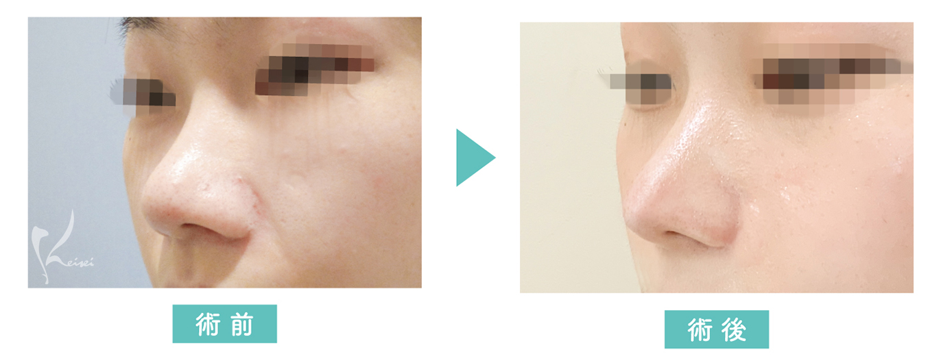 鼻プロテーゼ+小鼻縮小+耳介軟骨移植の症例写真
