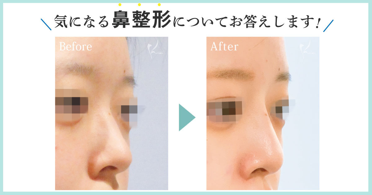 鼻整形のよくある質問 恵聖会クリニック 大阪の美容外科 美容皮膚科 鼻整形のよくある質問 恵聖会クリニック 大阪の美容外科 美容皮膚科