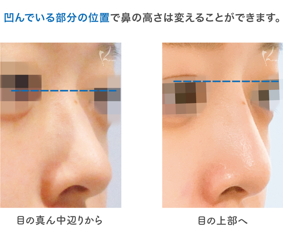 鼻を高くする鼻根部の位置設定