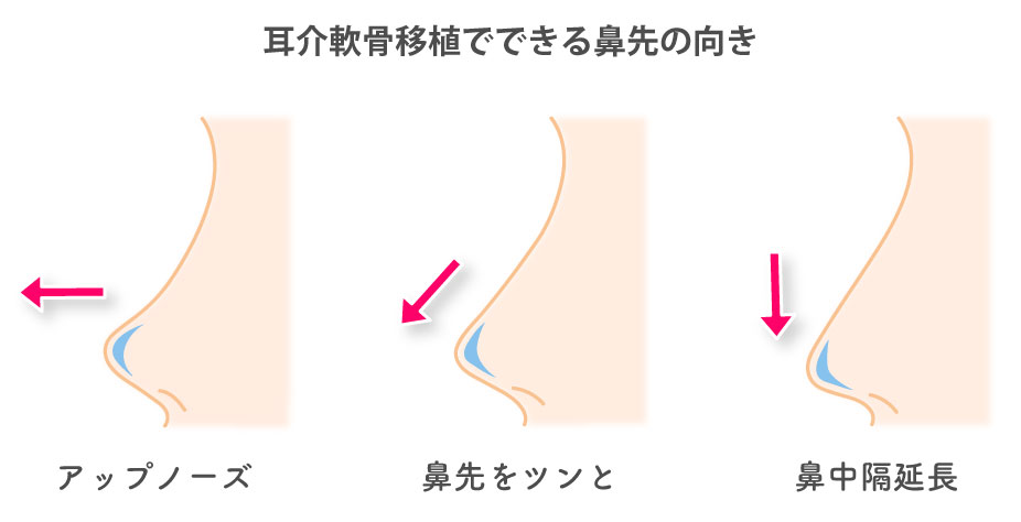 耳介軟骨移植でできる鼻先の向きの種類