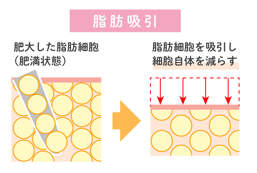 脂肪吸引による脂肪細胞の変化と仕組み