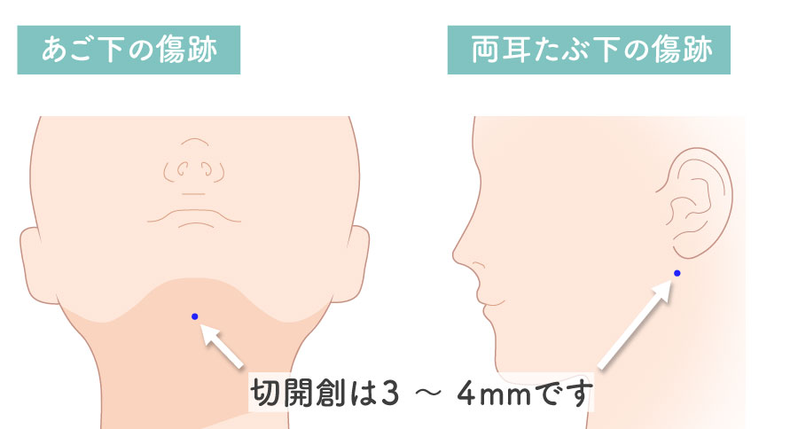 顔の脂肪吸引の傷跡（切開創）の箇所