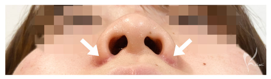 小鼻縮小の症例　下から見た傷跡
