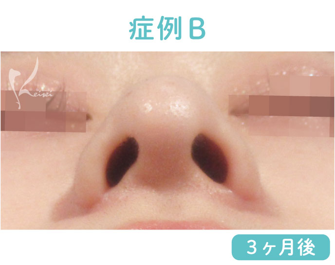 小鼻縮小 鼻翼縮小の3ヶ月後の傷跡