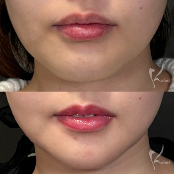 輪郭3点骨切りでここまで変わる｜余白を減らして小顔＆卵型輪郭へ　サムネイル