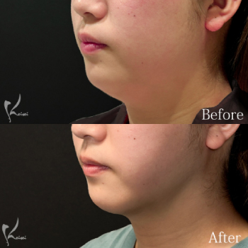 顔の脂肪吸引だけでここまで変わる｜3つの症例で小顔効果を解説　サムネイル