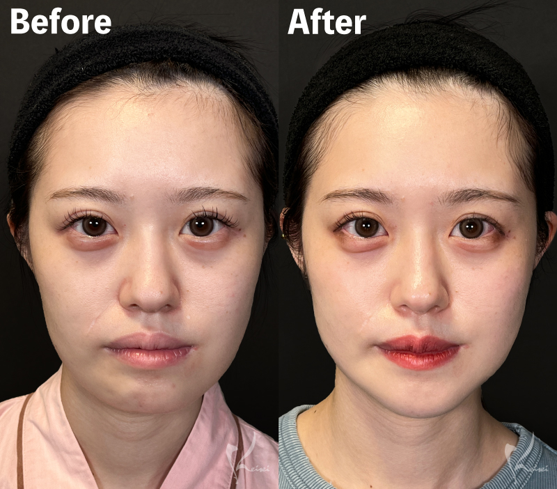 before・After写真（正面）