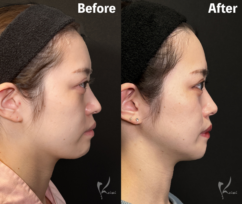before・After写真（側面）