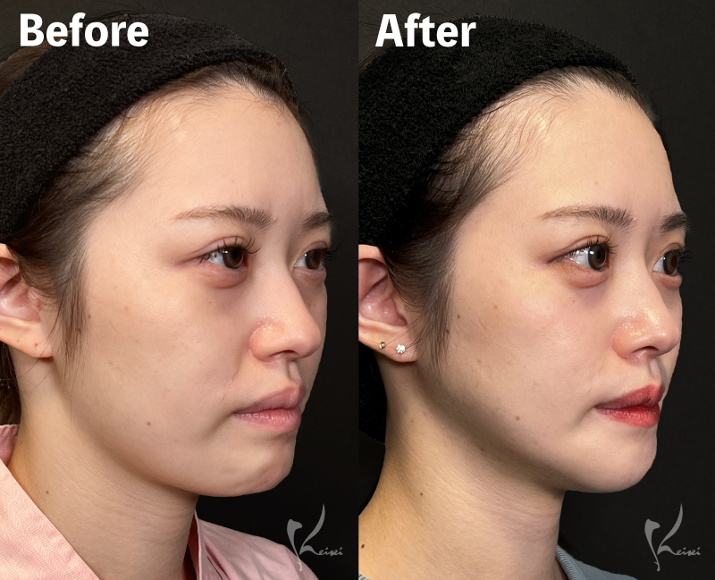 before・After写真（斜め面）