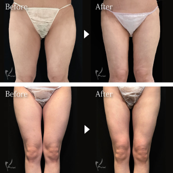 太もも脂肪吸引の症例解説｜「細さ」も「形」も重視したデザイン　サムネイル