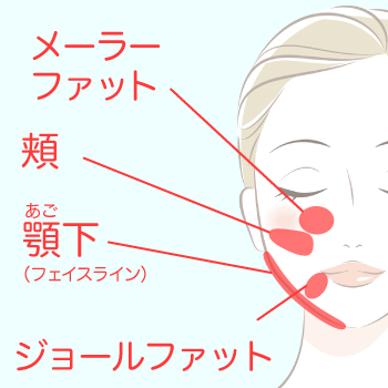 顔の脂肪吸引はどこまで変わる？小顔効果と限界を医師が解説　サムネイル