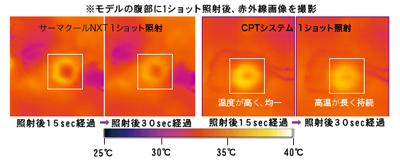 サーマクール cpt リフトアップ エイジングケア アンチエイジング