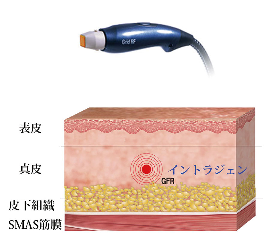 ウルトラセル hifu リフトアップ エイジングケア アンチエイジング 大阪 たるみ治療