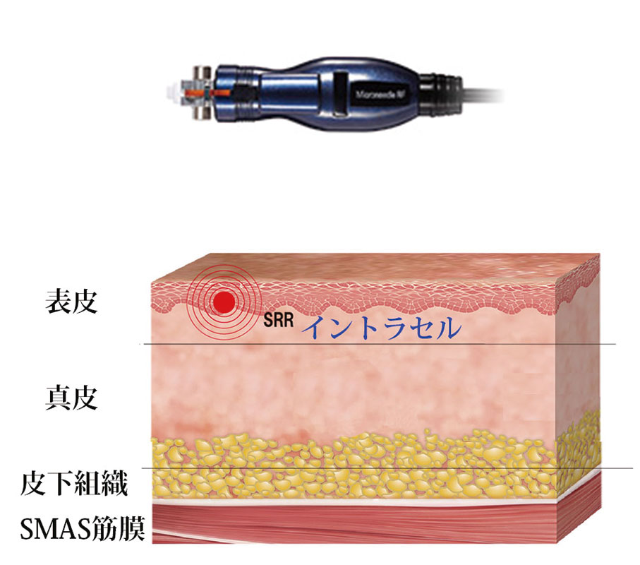 ウルトラセル hifu リフトアップ エイジングケア アンチエイジング 大阪 たるみ治療