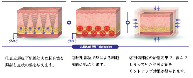 ウルトラセル hifu リフトアップ エイジングケア アンチエイジング 大阪 たるみ治療