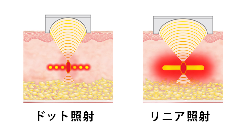 ドット照射とリニア照射の違い