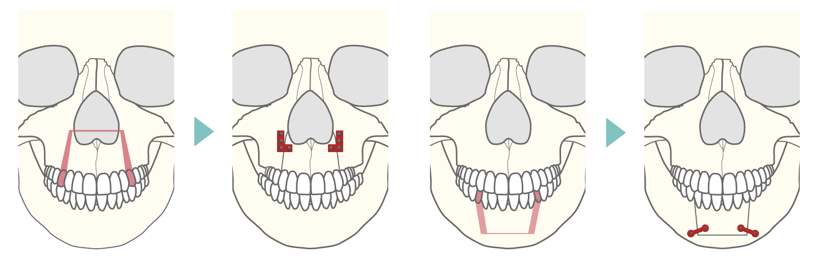 上下顎分節骨切り術式の正面からのイメージ