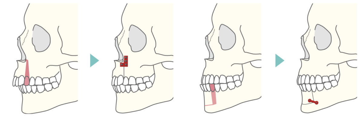 上下顎分節骨切り術式の横からのイメージ