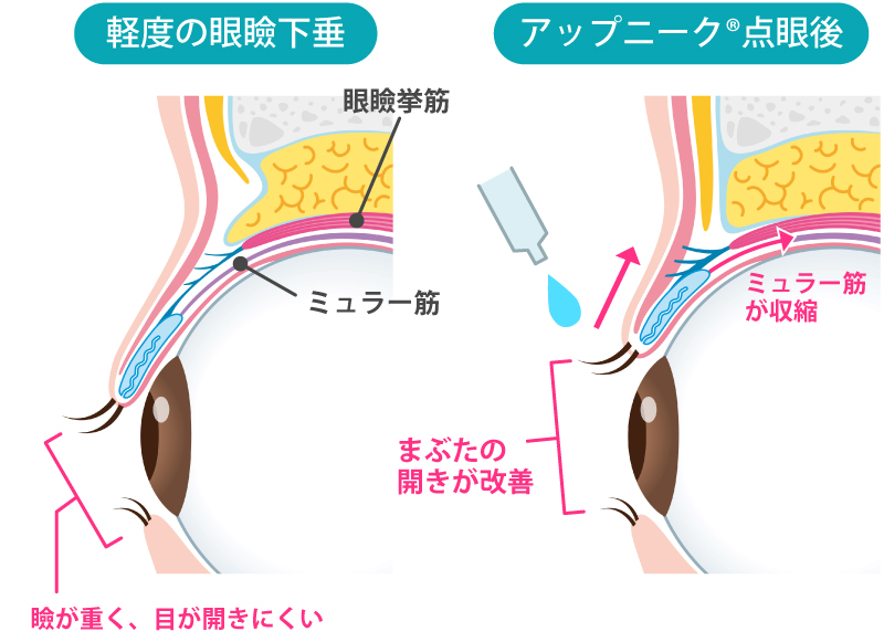 アップニークの作用機序