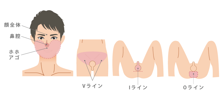 医療レーザー 脱毛 エステ 永久脱毛 レーザー脱毛 ダイオード ソプラノ ジェントル  男性Vライン　男性Iライン　男性Oライン　男性VIO脱毛範囲