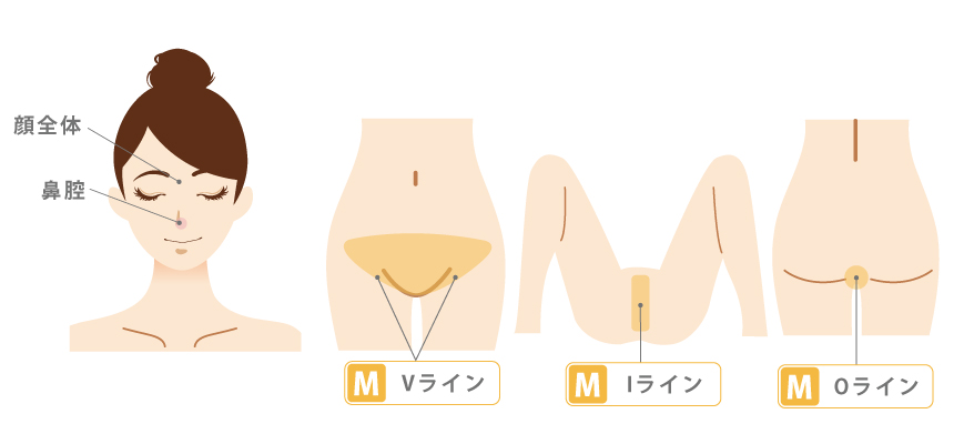 医療レーザー 脱毛 エステ 永久脱毛 レーザー脱毛 ダイオード ソプラノ ジェントル 女性　VIO ハイジニーナ　ビキニ　Iライン　Oライン　施術範囲