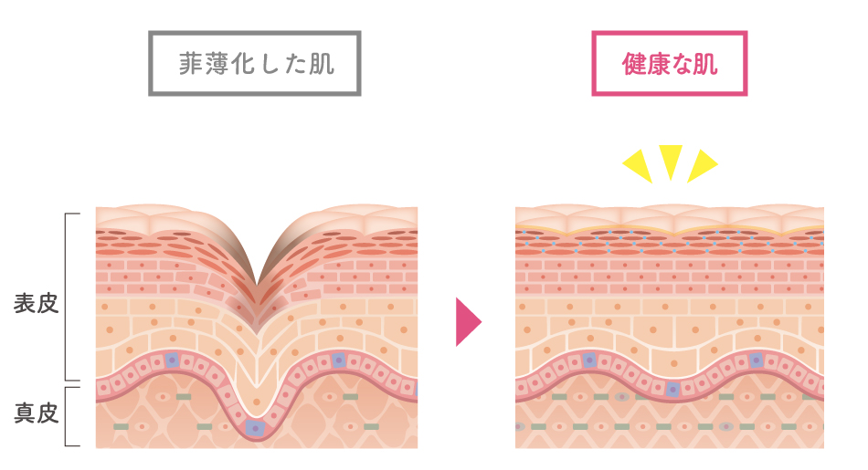 ヒアルロン酸ボライトXCによる肌質改善の様子