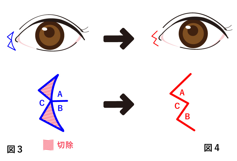 目頭切開 内田法(W形成)の説明図