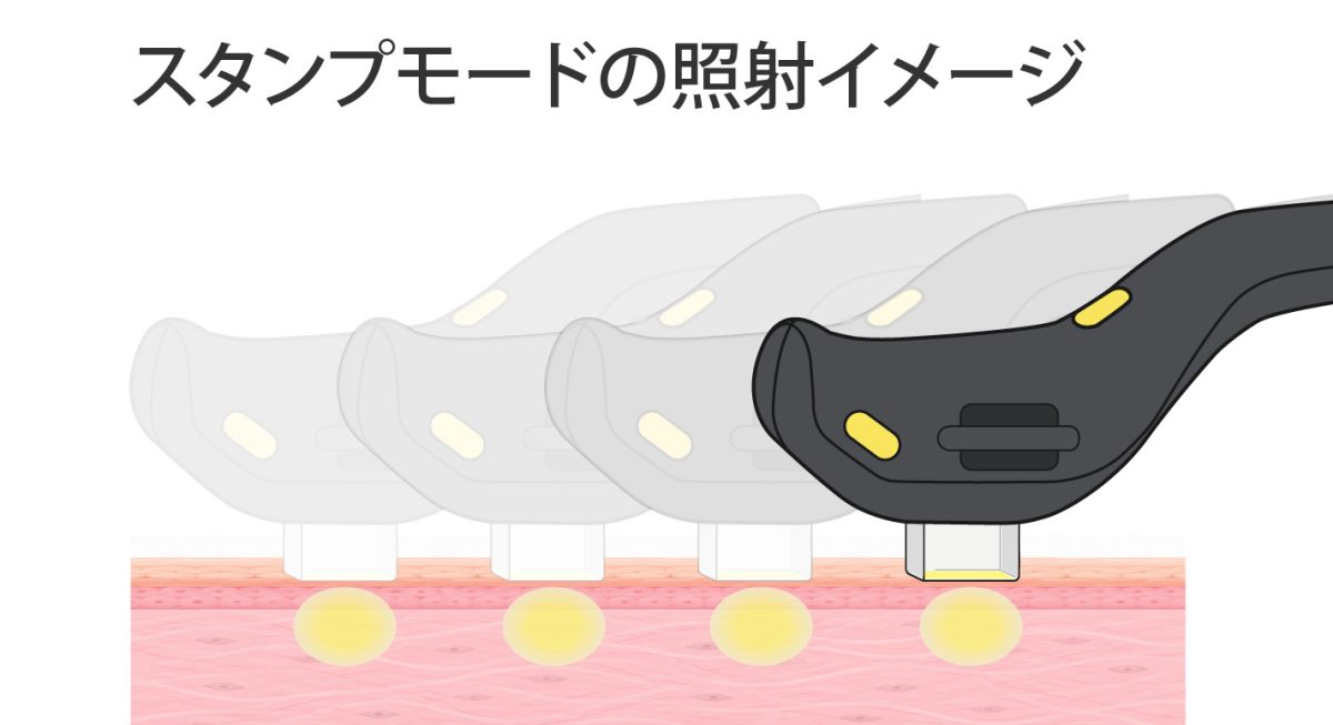 フォトフェイシャル ステラM22 XPL スタンプモードの照射イメージ